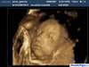 Ecograf&iacute;a 4D de Sammy con 32 semanas de gestaci&oacute;n 02